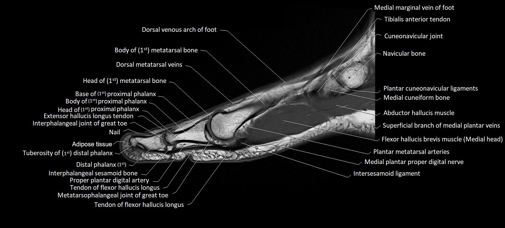 MRI foot sagittal labelled cross sectional anatomy image  5.webp